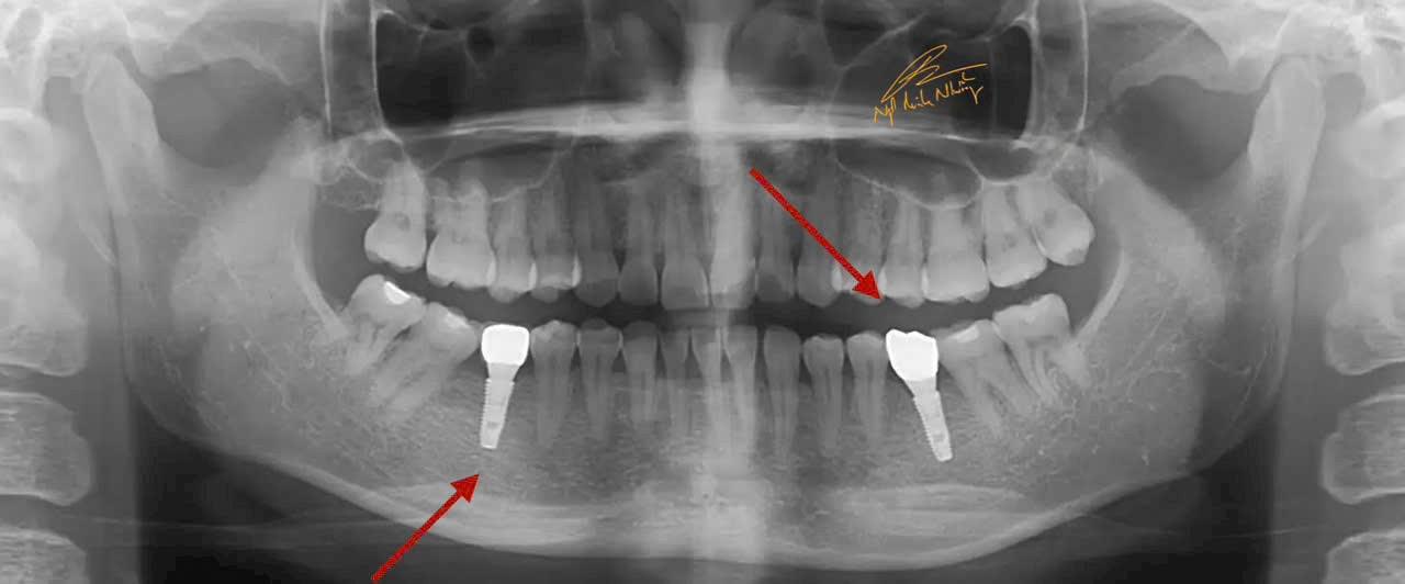 Kết thúc ca, các răng về đúng vị trí, phục hồi được các răng mất bằng implant. (ca được BS Ngô Minh Nhưỡng thực hiện trong thời gian hơn 01 năm)