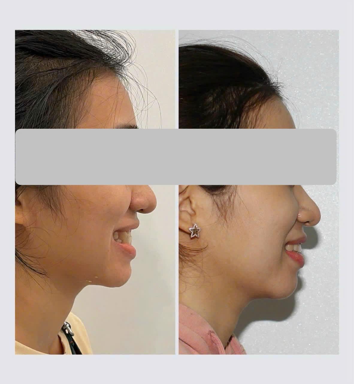 Niềng răng có thể làm thay đổi một phần khuôn mặt, nhưng mức độ thay đổi phụ thuộc vào từng trường hợp cụ thể.