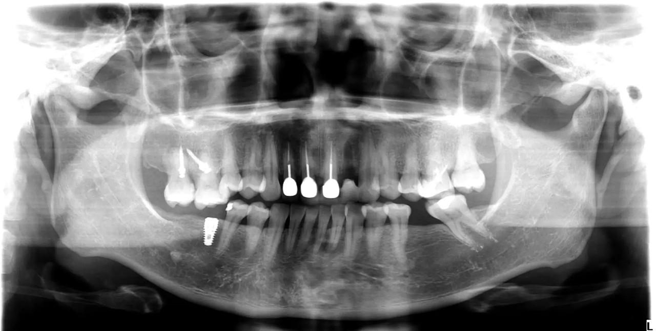 Hình ảnh toàn cảnh trước khi hoàn tất kéo lún các răng trên. Trường hợp này còn có nhiều chỗ mất răng khác.