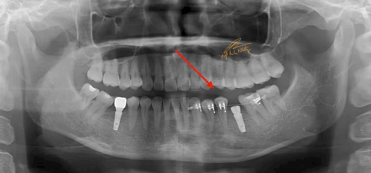 Trường hợp này phải chỉnh nha tiền phục hình, di chuyển các răng lệch về đúng vị trí để có khoảng phục hình răng trên implant.