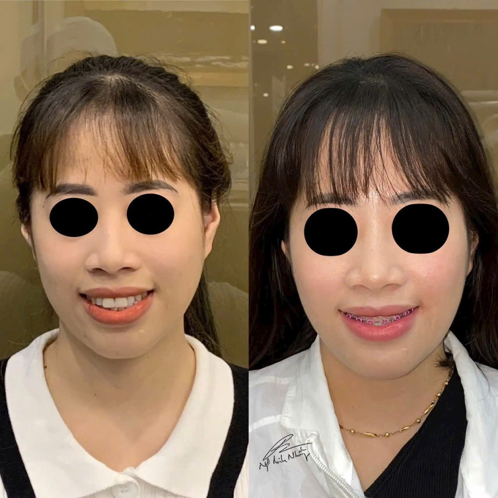niềng răng có thể làm thay đổi đường E-line, nhưng mức độ thay đổi sẽ tùy thuộc vào tình trạng răng miệng và cấu trúc khuôn mặt của mỗi người.