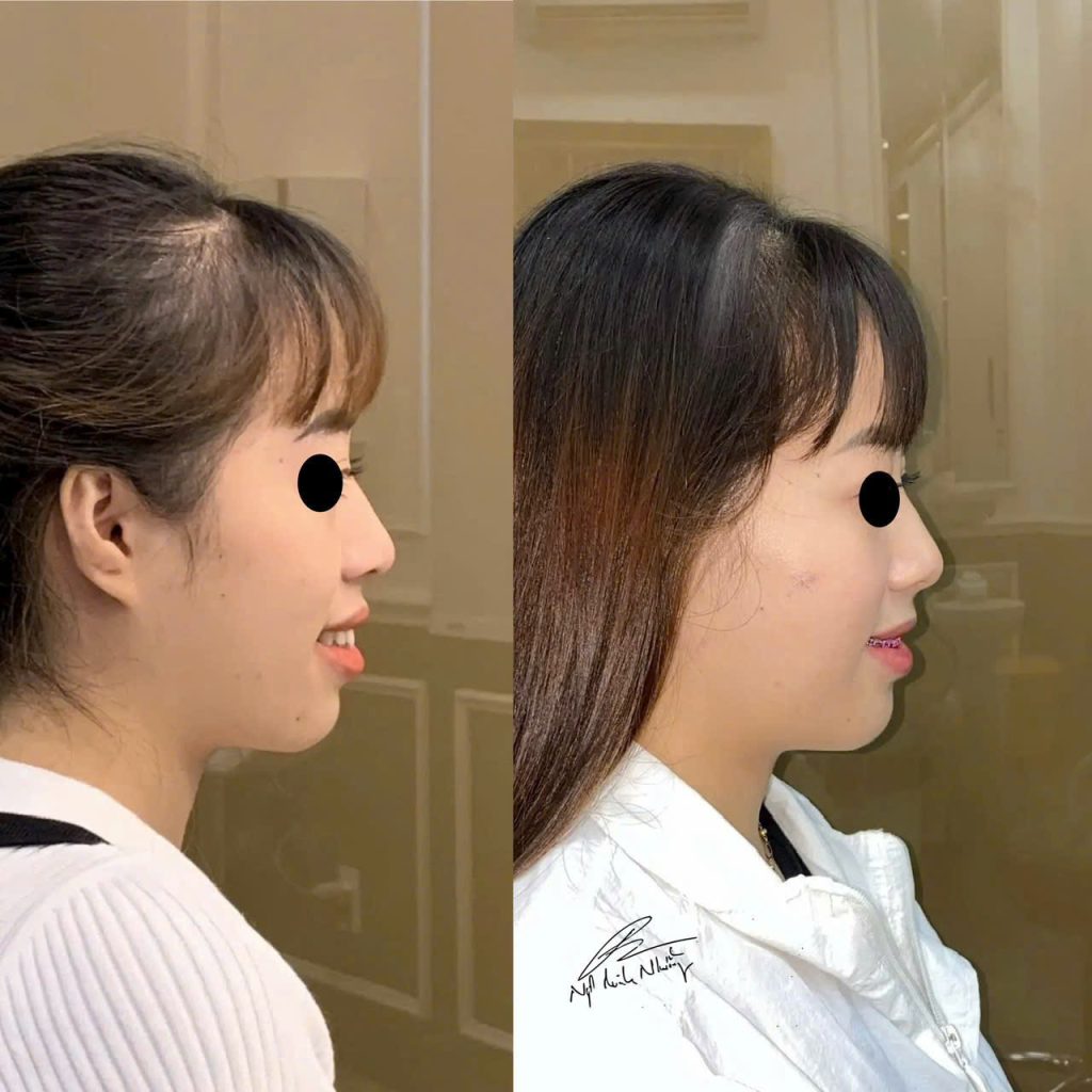 Nếu vấn đề liên quan đến các yếu tố khác như cấu trúc xương (ví dụ như cằm quá ngắn hoặc quá dài), niềng răng một mình sẽ không thể thay đổi được đường E-line đáng kể. Trong những trường hợp này, có thể cần đến các can thiệp phẫu thuật như chỉnh hàm hoặc thẩm mỹ mũi.