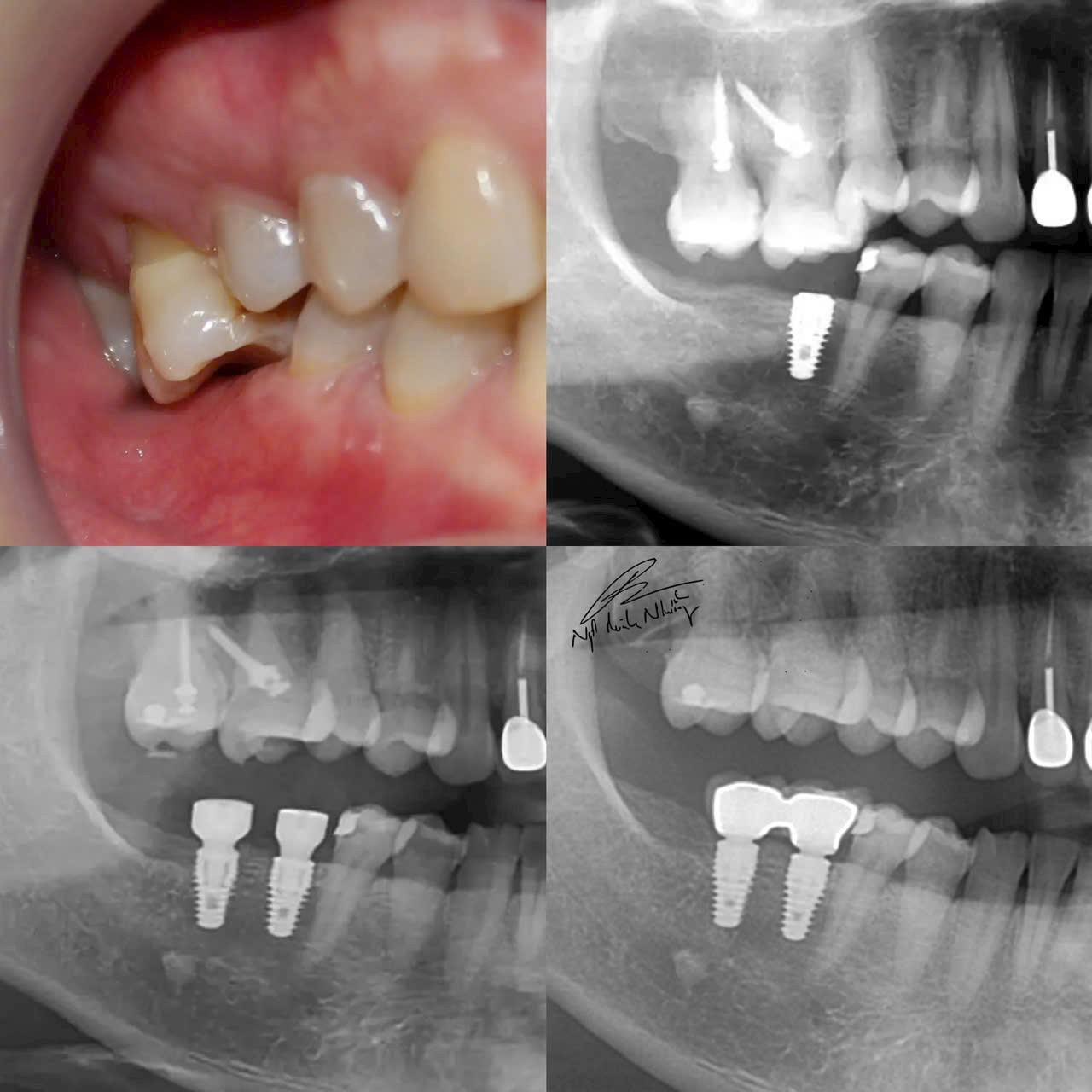 Ca mất răng lâu ngày không phục hồi, các răng đối diện hàm trên bị trồi, không đủ khoảng để trồng răng dưới. Sau khi dùng kỹ thuật kéo lún các răng hàm trên về vị trí cũ, các răng hàm dưới đã có thể gắn răng trên implant. (Ca thực hiện bởi BS Ngô Minh Nhưỡng).