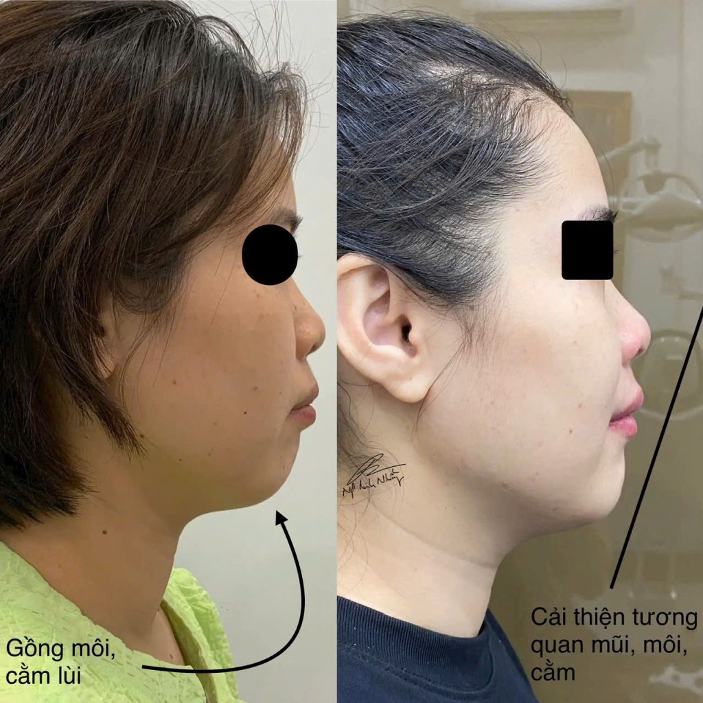 Trong một khuôn mặt đẹp, theo lý thuyết E-line, môi trên và môi dưới nên nằm ngay sau hoặc sát với đường này. Nếu các điểm như môi trên và môi dưới quá xa so với đường E-line, có thể khiến cho khuôn mặt bị mất cân đối và thiếu sự hài hòa.