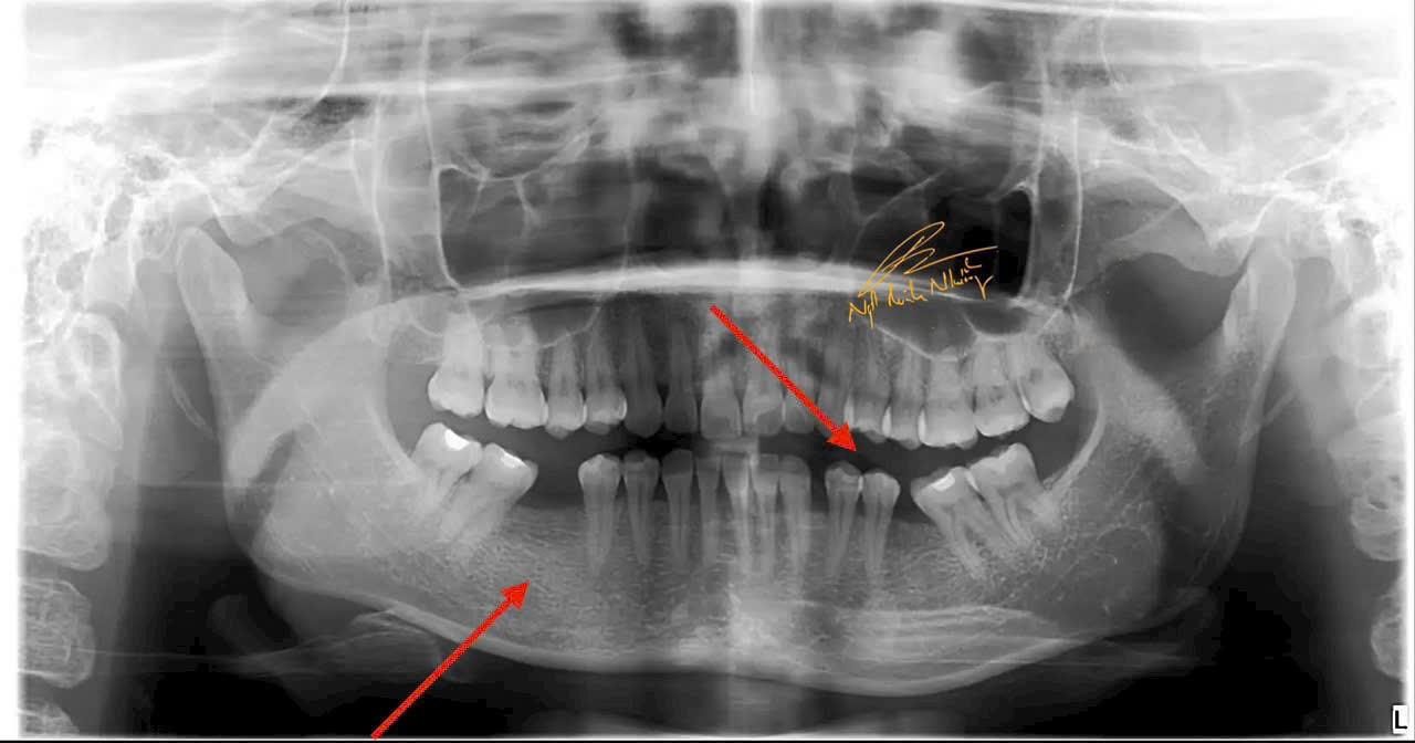 Một trường hợp khác mất răng lâu ngày, các răng bên cạnh xô đẩy, không có chỗ để trồng răng.