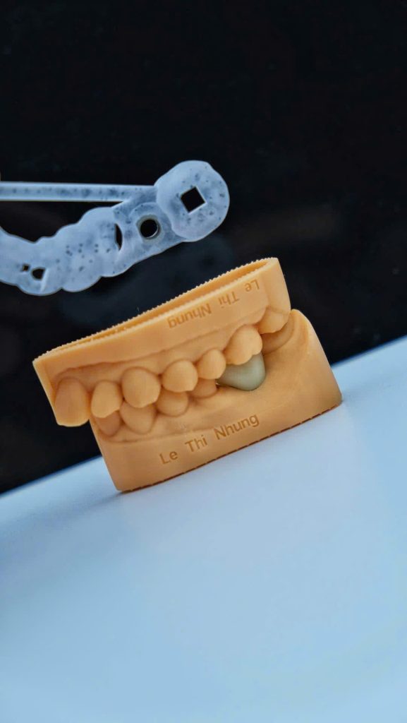Máng hướng dẫn phẫu thuật giúp định vị vị trí implant, phục hình răng tạm gắn tức thì ngay sau cắm trụ. Tất cả thành phần đều được thiết kế trước bằng phần mềm và in 3D.