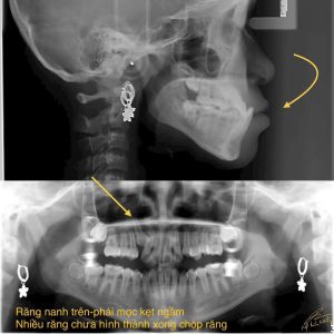 Niềng răng có thể là một quá trình khá phức tạp và đòi hỏi kiên nhẫn. Mức độ khó khăn của việc niềng răng phụ thuộc vào nhiều yếu tố như tình trạng răng miệng hiện tại, phương pháp niềng,