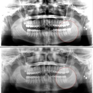 Sau khi nhổ răng khôn, để giảm thiểu đau đớn và hỗ trợ quá trình lành thương, bạn cần thực hiện một số biện pháp chăm sóc sau:
