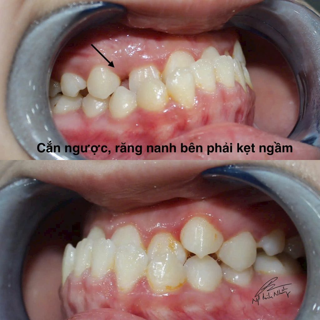 Niềng răng có thể là một quá trình khá phức tạp và đòi hỏi kiên nhẫn. Mức độ khó khăn của việc niềng răng phụ thuộc vào nhiều yếu tố như tình trạng răng miệng hiện tại, phương pháp niềng, và khả năng chăm sóc của bạn trong suốt quá trình điều trị.