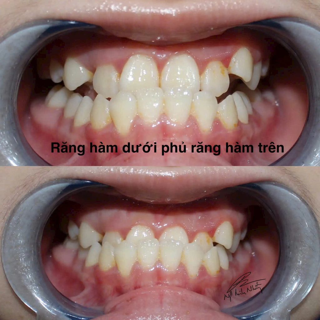 Niềng răng có thể là một quá trình khá phức tạp và đòi hỏi kiên nhẫn. Mức độ khó khăn của việc niềng răng phụ thuộc vào nhiều yếu tố như tình trạng răng miệng hiện tại, phương pháp niềng, và khả năng chăm sóc của bạn trong suốt quá trình điều trị.
