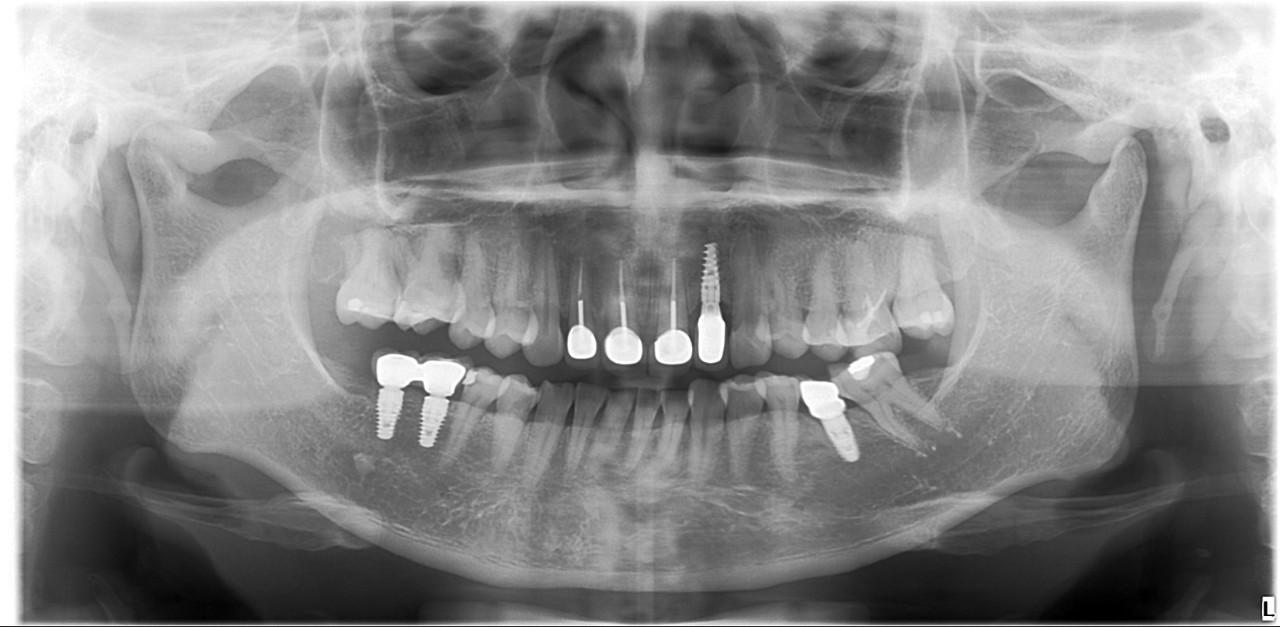 Hình ảnh toàn cảnh sau khi hoàn thiện phục hồi các răng mất bằng implant.