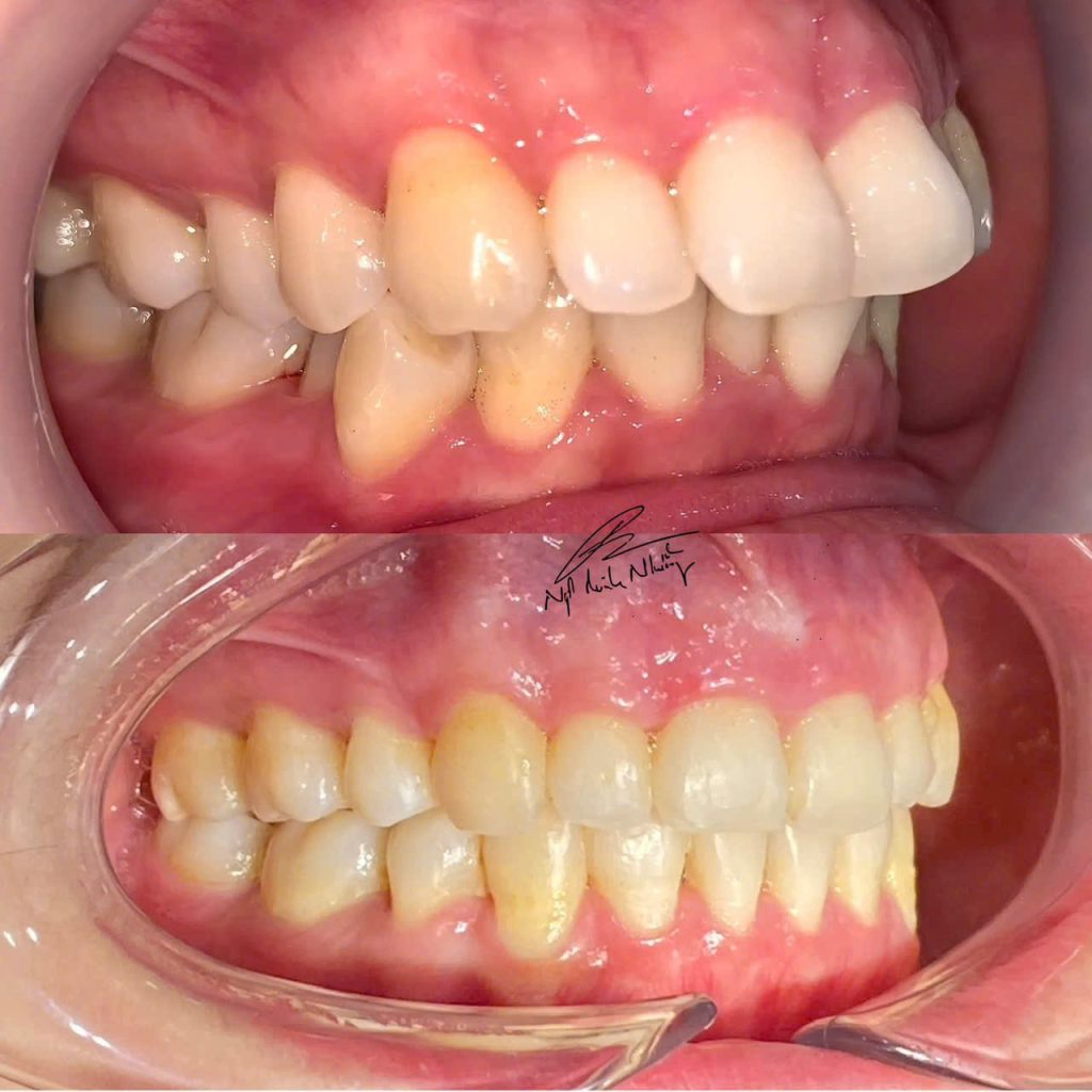 Niềng răng có thể ảnh hưởng đến đường E-line, nhưng mức độ thay đổi phụ thuộc vào các yếu tố như mức độ lệch lạc của răng, độ tuổi, và phương pháp niềng răng được áp dụng.