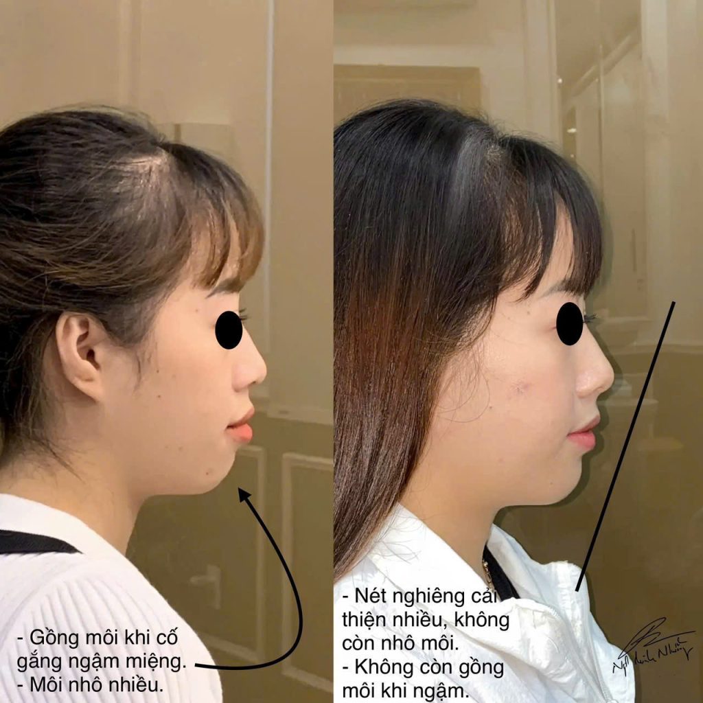 Tuy nhiên, việc thay đổi đường E-line bằng niềng răng chỉ có thể thực hiện được khi nguyên nhân lệch lạc là do vấn đề về răng miệng hoặc hàm.