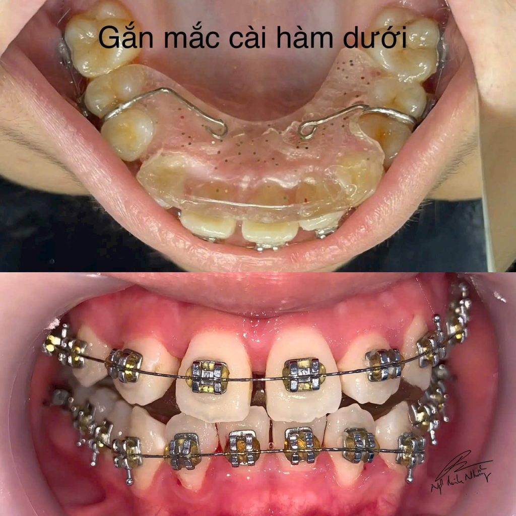 Niềng răng có thể là một quá trình khá phức tạp và đòi hỏi kiên nhẫn. Mức độ khó khăn của việc niềng răng phụ thuộc vào nhiều yếu tố như tình trạng răng miệng hiện tại, phương pháp niềng, và khả năng chăm sóc của bạn trong suốt quá trình điều trị.