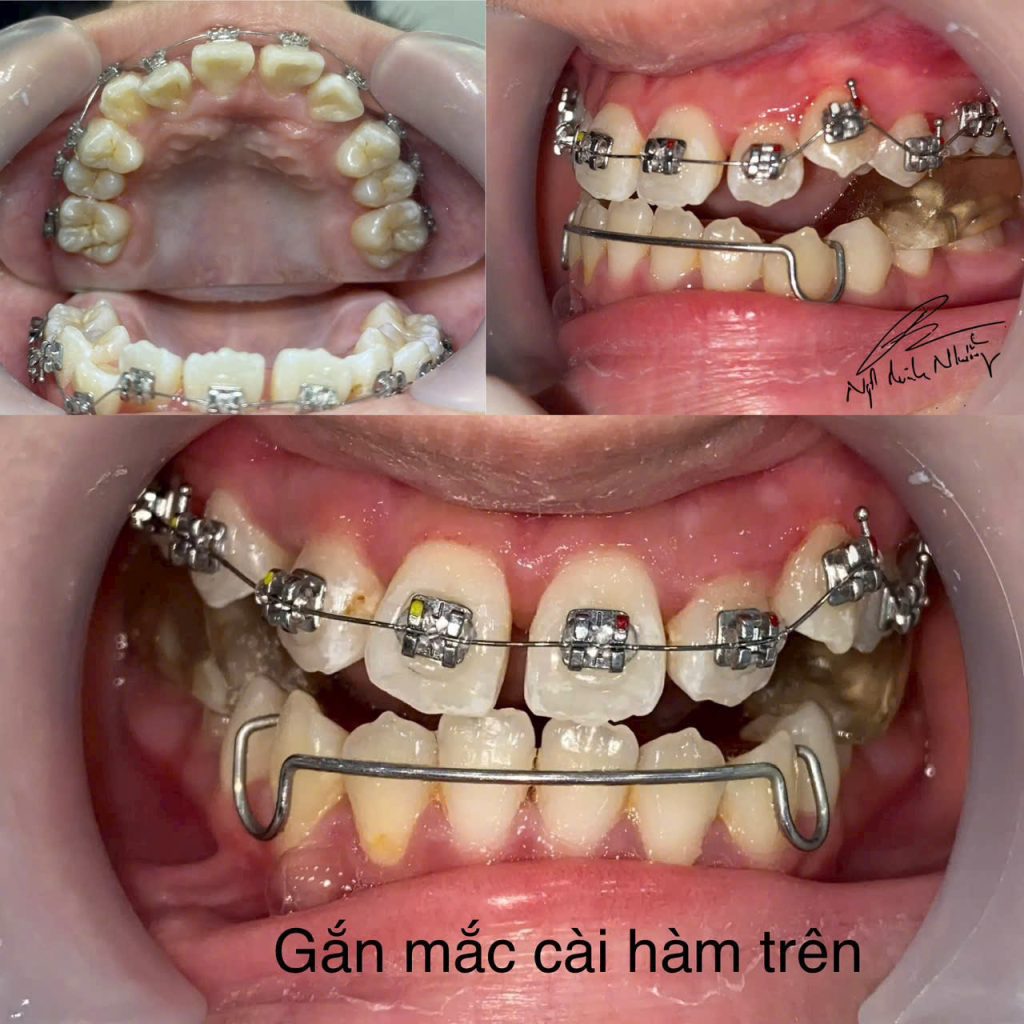 Niềng răng có thể là một quá trình khá phức tạp và đòi hỏi kiên nhẫn. Mức độ khó khăn của việc niềng răng phụ thuộc vào nhiều yếu tố như tình trạng răng miệng hiện tại, phương pháp niềng, và khả năng chăm sóc của bạn trong suốt quá trình điều trị.