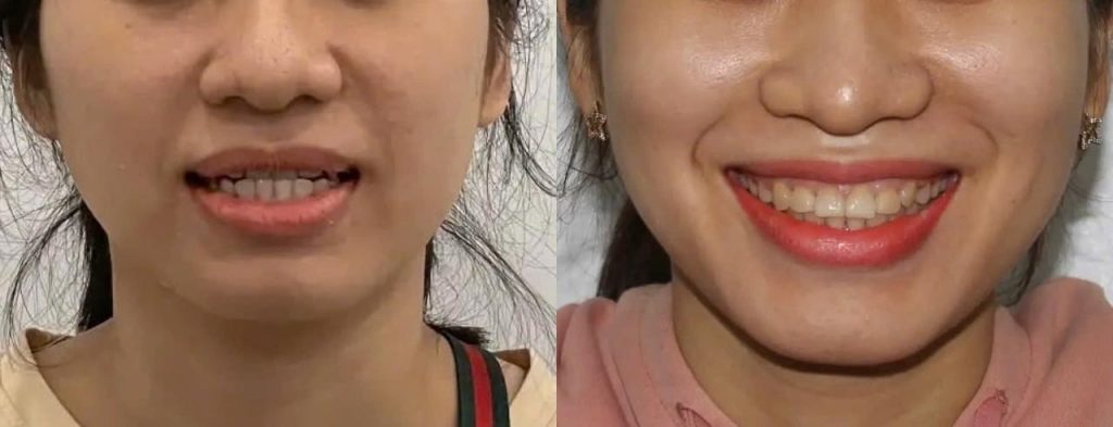 Mặc dù niềng răng có thể làm thay đổi một số khía cạnh của khuôn mặt, nhưng những thay đổi này chủ yếu là tích cực và hướng đến sự cân đối, hài hòa hơn.