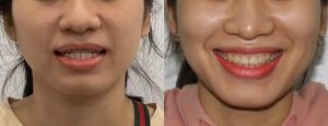 Mặc dù niềng răng có thể làm thay đổi một số khía cạnh của khuôn mặt, nhưng những thay đổi này chủ yếu là tích cực và hướng đến sự cân đối, hài hòa hơn.