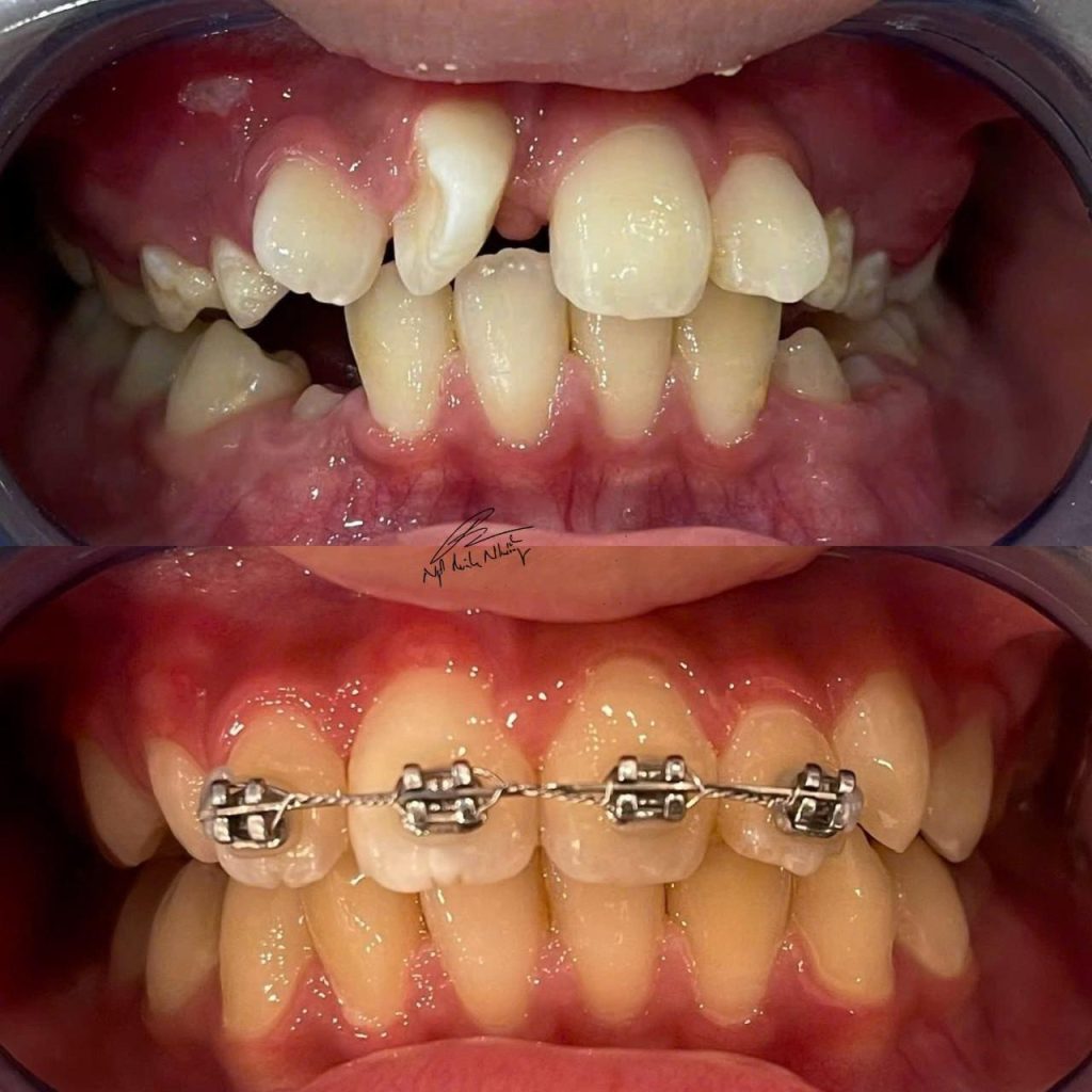 Giúp răng mọc đúng vị trí : Khi niềng răng sớm, bác sĩ có thể tạo không gian cho các răng vĩnh viễn mọc đúng vị trí, giúp tránh việc phải nhổ răng vĩnh viễn sau này nếu răng mọc chen chúc quá nhiều.
