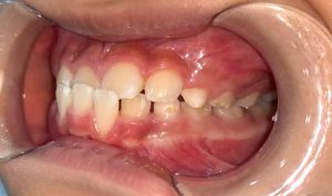 Niềng răng sớm ở trẻ em