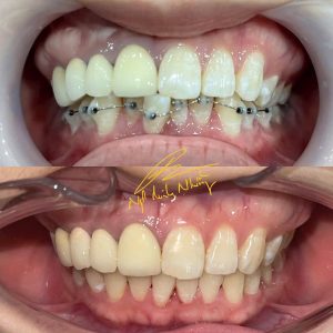 Nếu bạn chỉ gặp vấn đề ở một hàm như răng khấp khểnh, sai lệch khớp cắn, hoặc mất cân đối ở một bên hàm, bác sĩ có thể chỉ niềng hàm bị ảnh hưởng mà không cần niềng cả hai hàm.