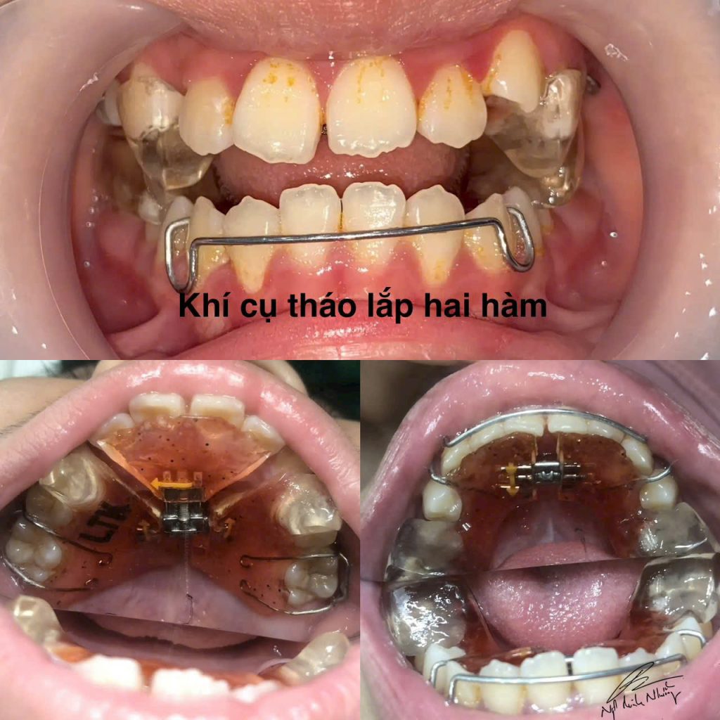 Niềng răng có thể là một quá trình khá phức tạp và đòi hỏi kiên nhẫn. Mức độ khó khăn của việc niềng răng phụ thuộc vào nhiều yếu tố như tình trạng răng miệng hiện tại, phương pháp niềng, và khả năng chăm sóc của bạn trong suốt quá trình điều trị.