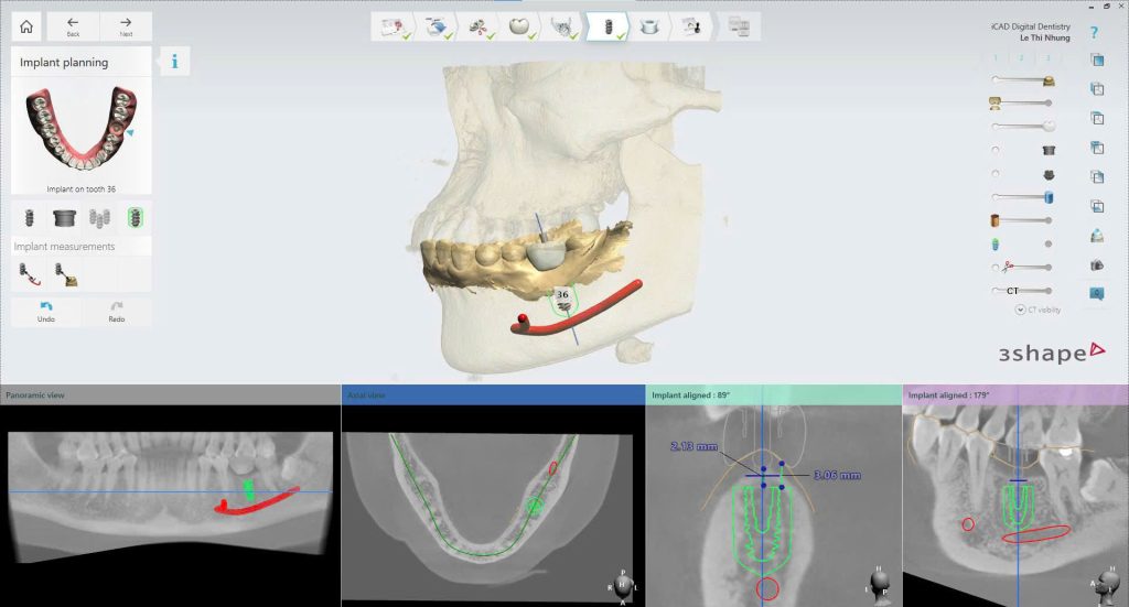 Định vị vị trí tối ưu trụ implant bằng phần mềm.