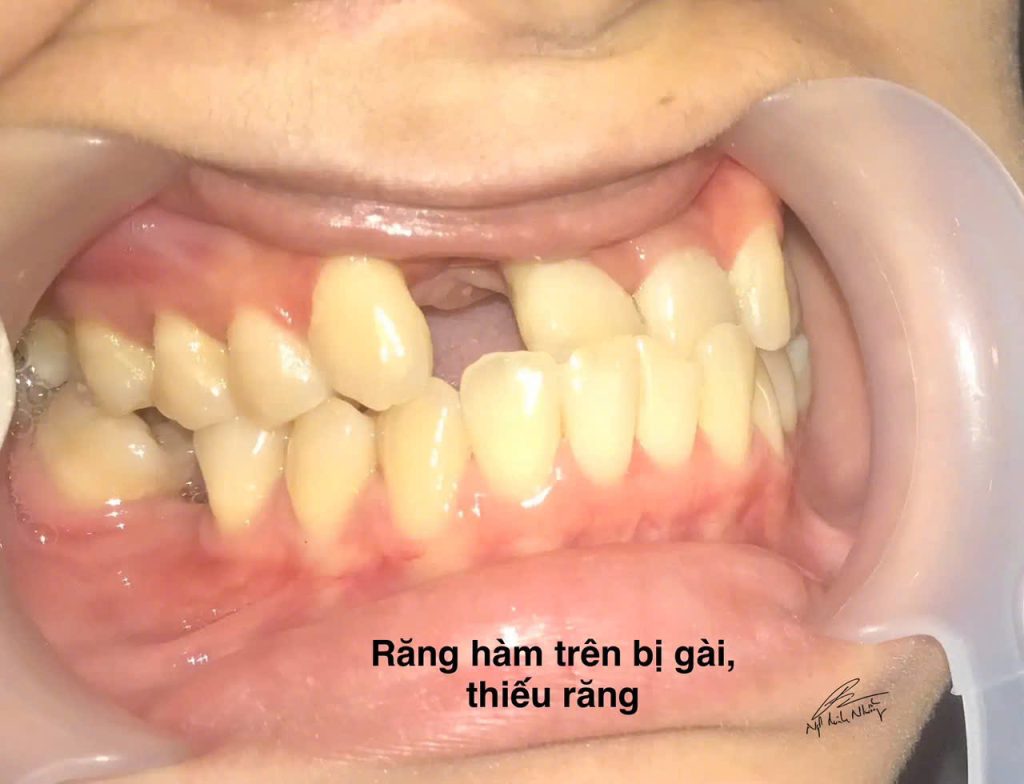 Răng khấp khểnh hoặc nhô ra có thể dễ bị va đập và chấn thương trong các tình huống va chạm hoặc trong các hoạt động thể thao. Niềng răng giúp cải thiện sự ổn định của hàm răng, từ đó giảm nguy cơ bị thương tổn.
