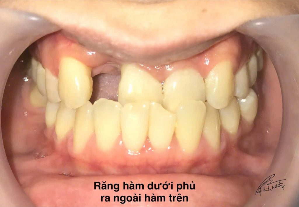 Việc cải thiện chức năng ăn nhai, giảm các vấn đề về răng miệng, cũng như tăng cường sự tự tin đều là những lợi ích đáng kể khi quyết định niềng răng.