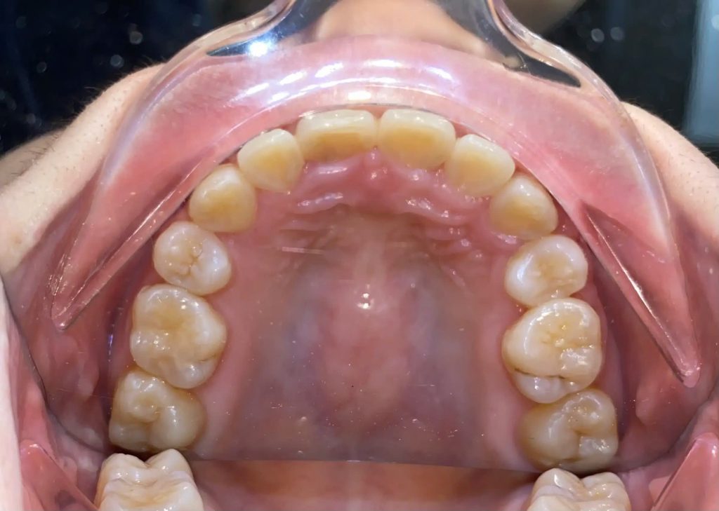 Niềng răng là phương pháp phổ biến để điều chỉnh răng khấp khểnh, giúp răng đều đặn hơn và cải thiện khớp cắn.