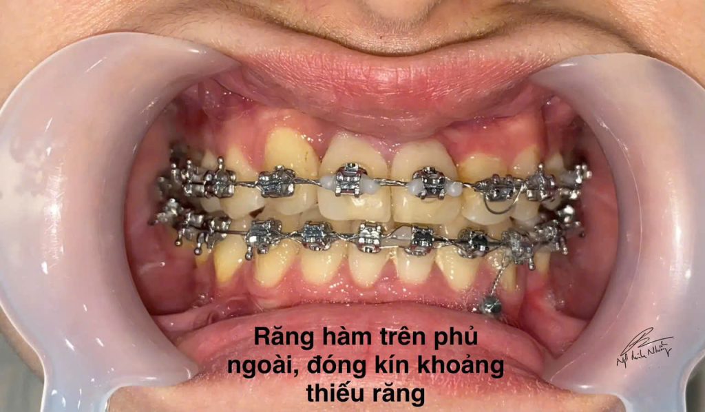 Cảm giác hài lòng với ngoại hình có thể cải thiện sức khỏe tinh thần, giúp bạn cảm thấy thoải mái hơn trong cuộc sống hàng ngày.