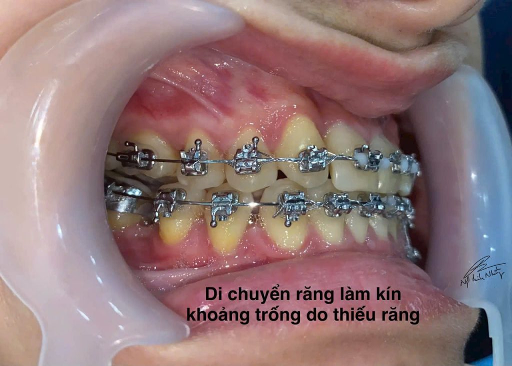 Niềng răng giúp cải thiện thẩm mỹ của hàm răng, giúp bạn tự tin hơn khi cười và giao tiếp. Một hàm răng đều đặn và đẹp giúp bạn cảm thấy tự tin hơn trong các tình huống xã hội, giao tiếp và công việc.