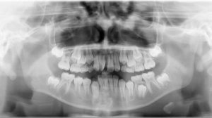 Giúp răng mọc đúng vị trí : Khi niềng răng sớm, bác sĩ có thể tạo không gian cho các răng vĩnh viễn mọc đúng vị trí, giúp tránh việc phải nhổ răng vĩnh viễn sau này nếu răng mọc chen chúc quá nhiều.