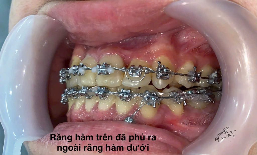 Niềng răng giúp chỉnh sửa các vấn đề này, cải thiện khả năng ăn nhai, giúp bạn thưởng thức bữa ăn dễ dàng hơn và không gặp phải các vấn đề về tiêu hóa do ăn uống không đúng cách.