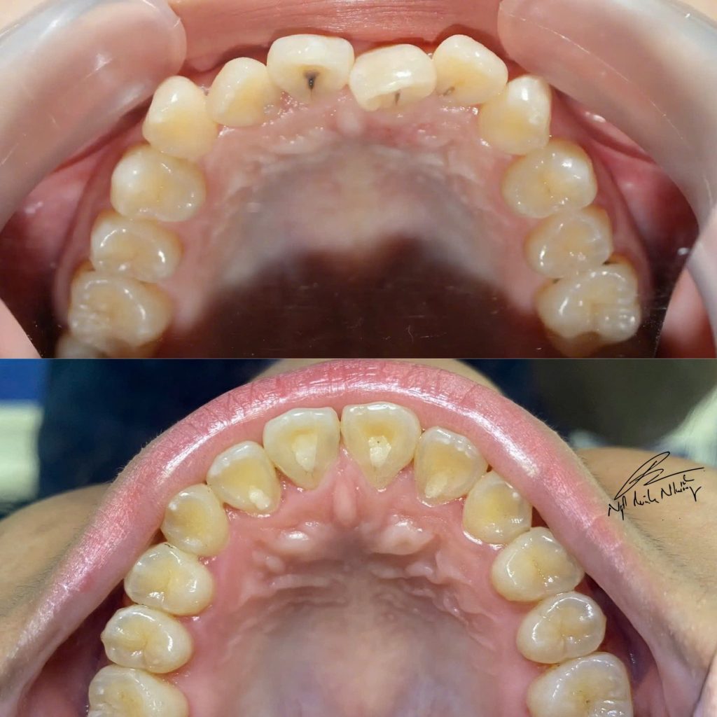 Niềng răng là lựa chọn lý tưởng nếu bạn muốn cải thiện sự đều đặn của răng và khớp cắn một cách lâu dài.