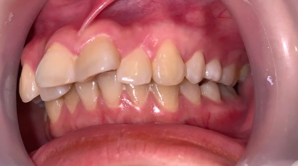 Răng khấp khểnh khiến việc chải răng đúng cách và dùng chỉ nha khoa trở nên khó khăn hơn, tạo điều kiện cho vi khuẩn và mảng bám tích tụ trên bề mặt răng.