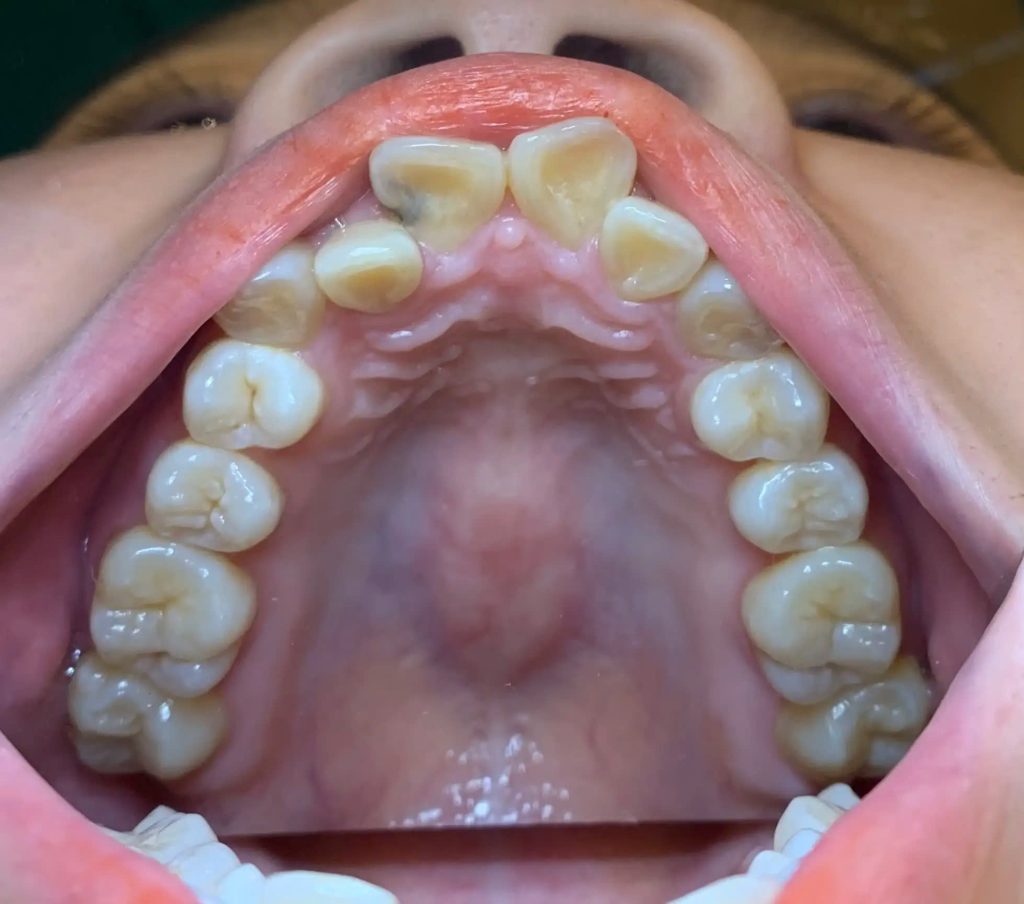Răng khấp khểnh có thể khiến một số người hình thành các thói quen xấu như cắn môi, nghiến răng hoặc cắn móng tay để điều chỉnh lại cảm giác hoặc giảm bớt sự khó chịu trong việc khớp cắn.