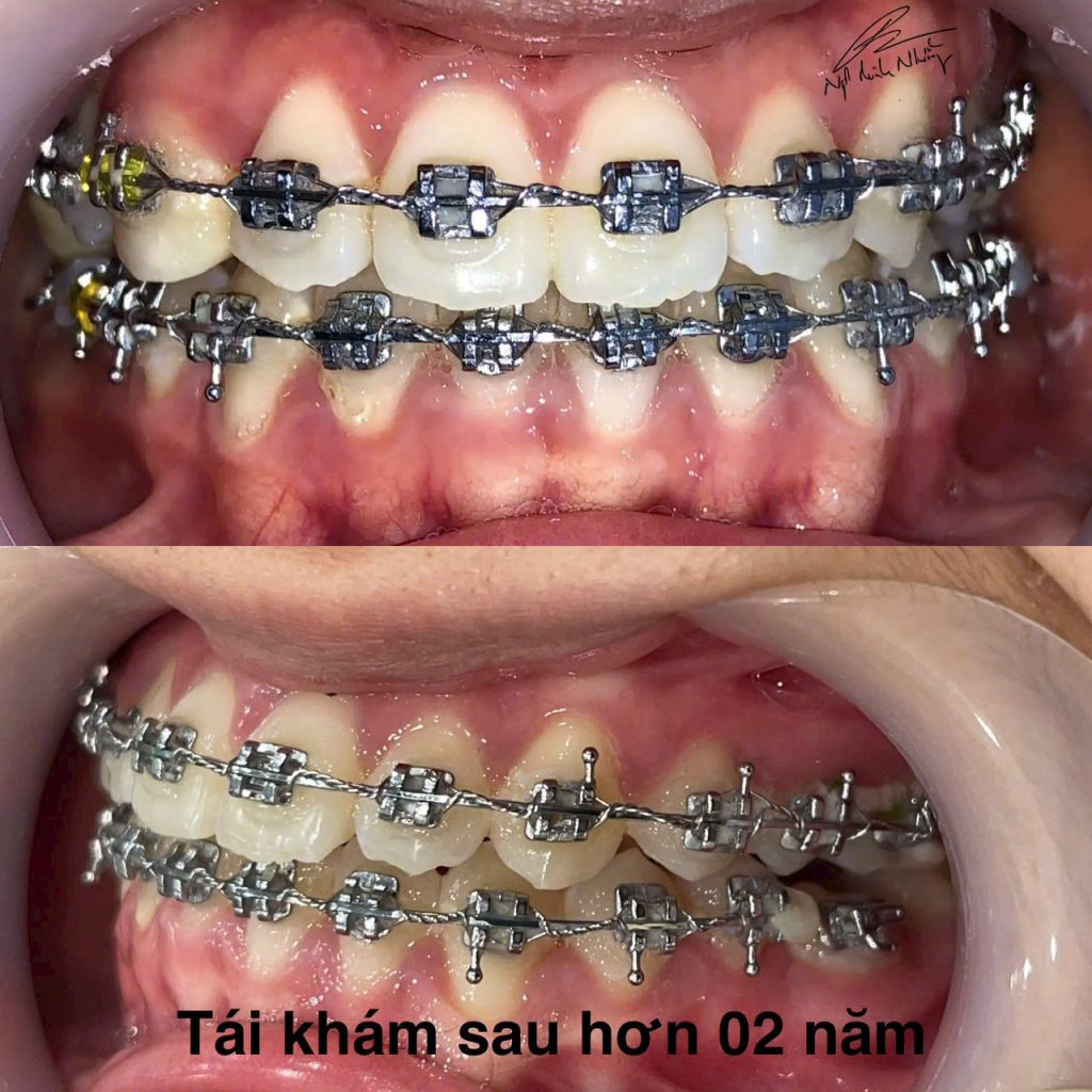 Niềng răng có thể là một quá trình khá phức tạp và đòi hỏi kiên nhẫn. Mức độ khó khăn của việc niềng răng phụ thuộc vào nhiều yếu tố như tình trạng răng miệng hiện tại, phương pháp niềng, và khả năng chăm sóc của bạn trong suốt quá trình điều trị.