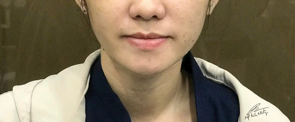 Niềng răng giúp chỉnh sửa các vấn đề này, cải thiện khả năng ăn nhai, giúp bạn thưởng thức bữa ăn dễ dàng hơn và không gặp phải các vấn đề về tiêu hóa do ăn uống không đúng cách.