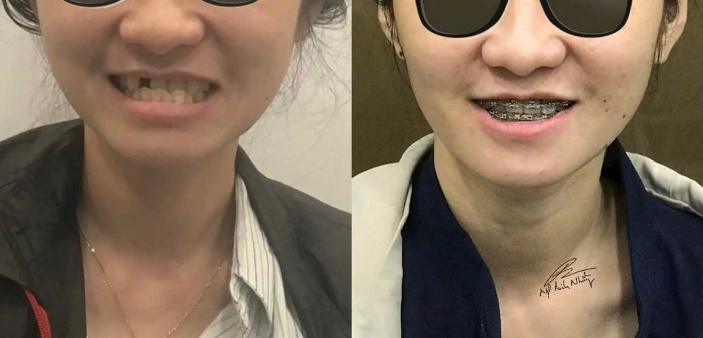 Niềng răng không chỉ thay đổi vẻ ngoài của bạn mà còn có tác động tích cực đến sức khỏe và tinh thần, cải thiện chất lượng sống lâu dài. Việc cải thiện chức năng ăn nhai, giảm các vấn đề về răng miệng, cũng như tăng cường sự tự tin đều là những lợi ích đáng kể khi quyết định niềng răng.