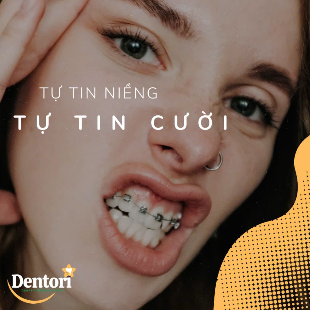 Niềng răng không chỉ cải thiện vẻ ngoài của bạn mà còn có thể thay đổi chất lượng sống theo nhiều cách tích cực.