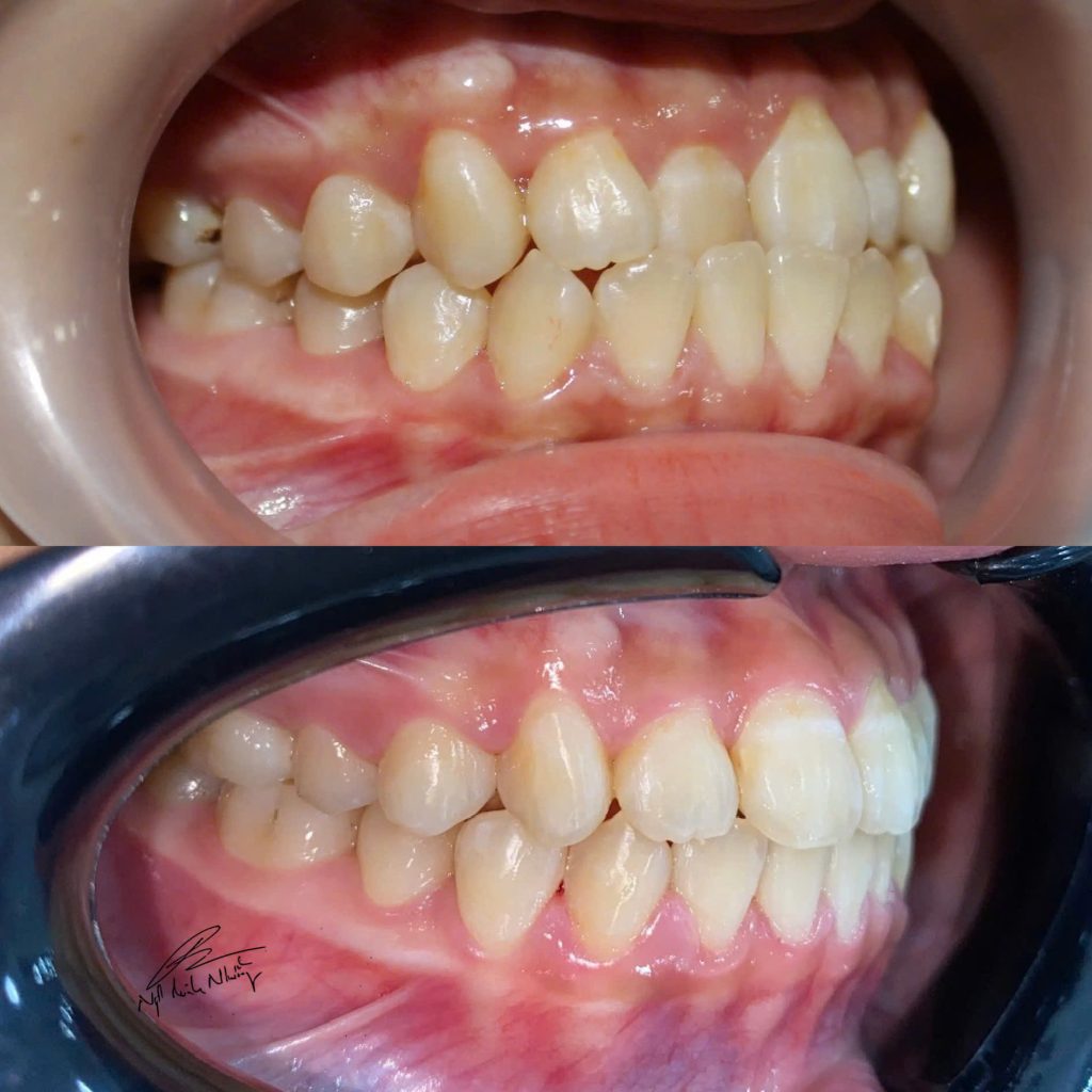 Thay đổi khớp cắn nhờ niềng răng.