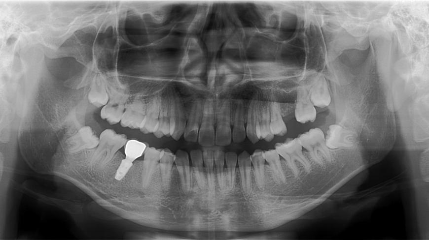 Về mặt bền vững, răng implant có thể rất bền nếu được chăm sóc đúng cách và nếu bạn có đủ xương hàm để hỗ trợ trụ implant.