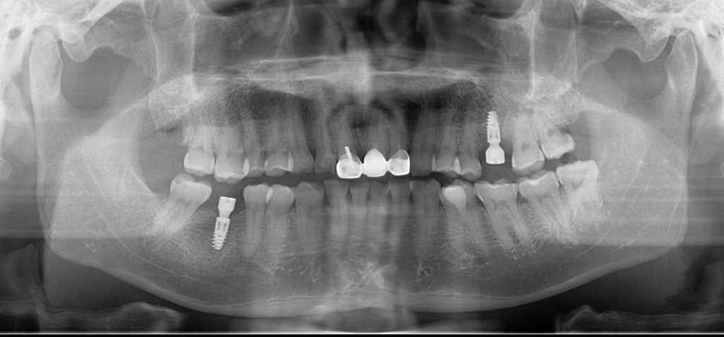Đặc biệt, rất nhiều trường hợp sau cấy ghép implant không cần uống thuốc giảm đau do không có cảm giác đau. Điều này phụ thuộc rất nhiều vào kinh nghiệm của phẫu thuật viên.
