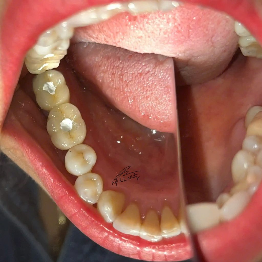 Răng sứ trên implant có lỗ vít